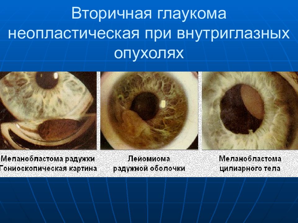Классификация глаукомы. Факотопическая глаукома. Постувеальная вторичная глаукома. Вторичная факолитическая глаукома.