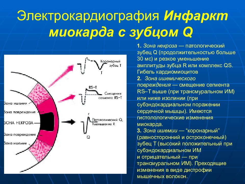 Основным экг признаком некроза сердечной мышцы является. Инфаркт миокарда с зубцом q. Дисметаболические изменения в миокарде. Инфаркт миокарда с зубцом q и без зубца q. Зона некроза на ЭКГ при инфаркте миокарда.