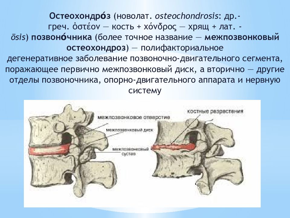 Остеохондроз позвоночника презентация