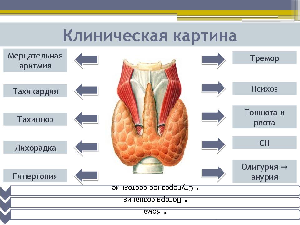 Тиреотоксический криз картинки