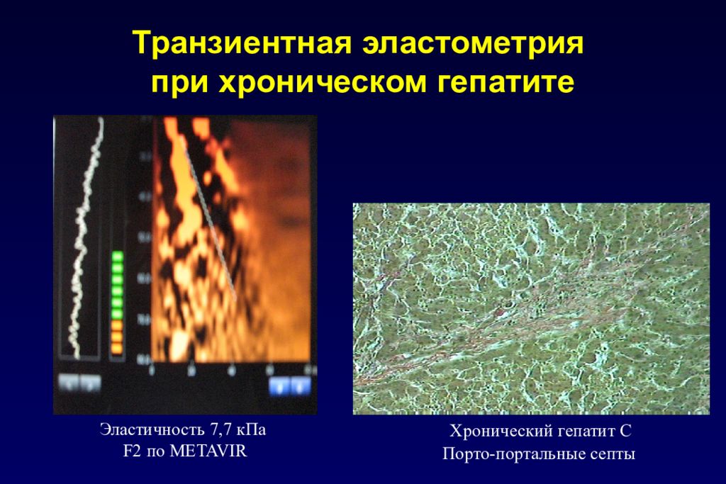 Эластометрия. Эластография печени классификация. Транзиентная эластометрия. Транзиентная эластография печени. Транзиторная эластометрия.