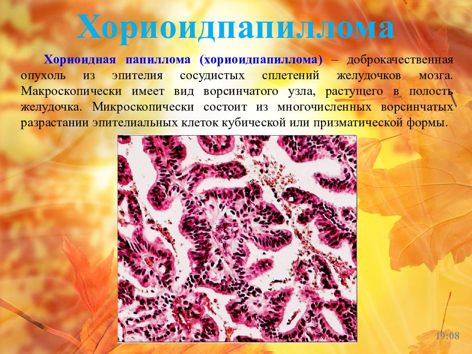 Папиллома эпителия. Хориоидная папиллома макропрепарат. Папиллома сосудистого сплетения. Хориоидпапиллома опухоль.