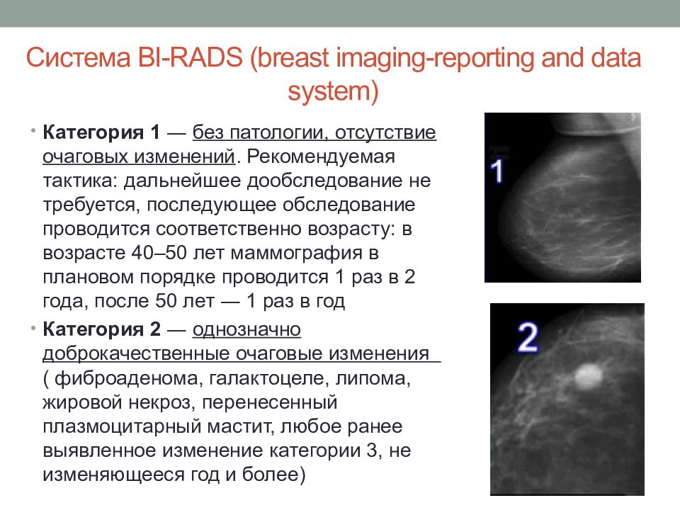 Справа bi rads 2. Birads 2 молочной железы что это такое. Rads 3 молочной железы. Birads 4 молочной железы что это такое. Классификация bi-rads молочных желез в маммографии.