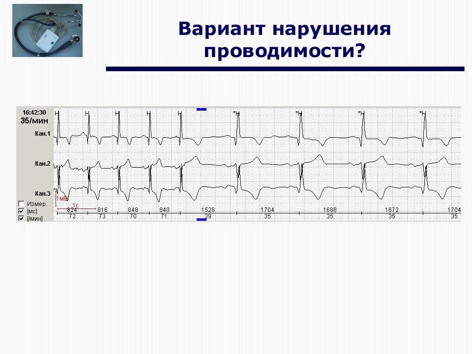 Экг нарушение проводимости. Холтеровское мониторирование ЭКГ Аксельрод. Холтеровское мониторирование ЭКГ возможности трудности ошибки. Орлов основы ЭКГ. ЭКГ холтеровский Валента мн-08 схема.