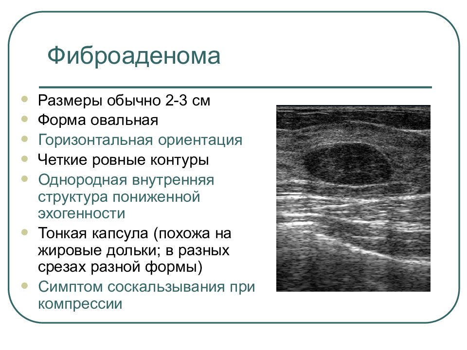 Диагноз молочной железы. Однородная. БЕЗЛУЧЕВАЯ внутренняя структура.. Очаги повышенной эхогенности в жировых дольках молочных желез.