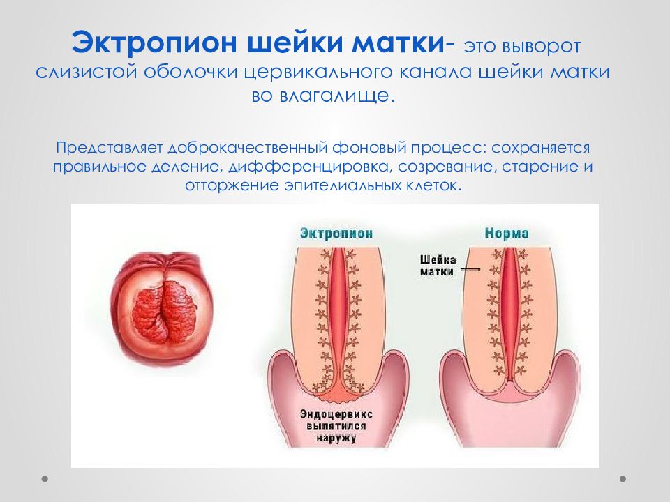 Эктропион лечение. Цервикальный эктропион. Врожденный эктропион шейки матки.