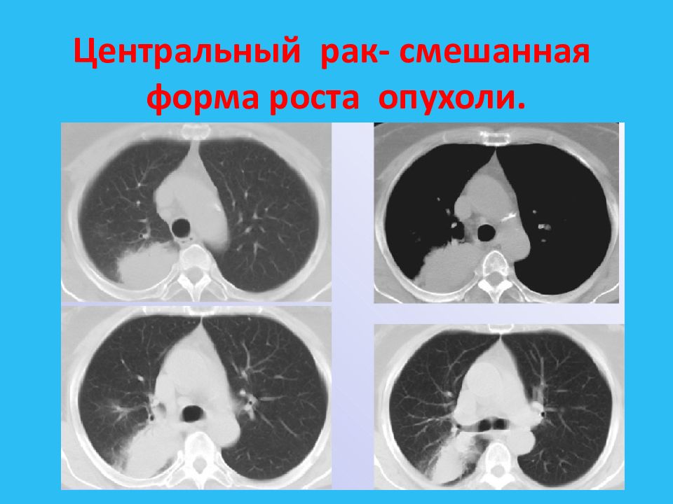 Центральный рак легкого. Смешанная форма роста опухоли. Злокачественная смешанная. Злокачественная смешанная Мюллерова опухоль. Смешанная форма роста опухоли на человеке.