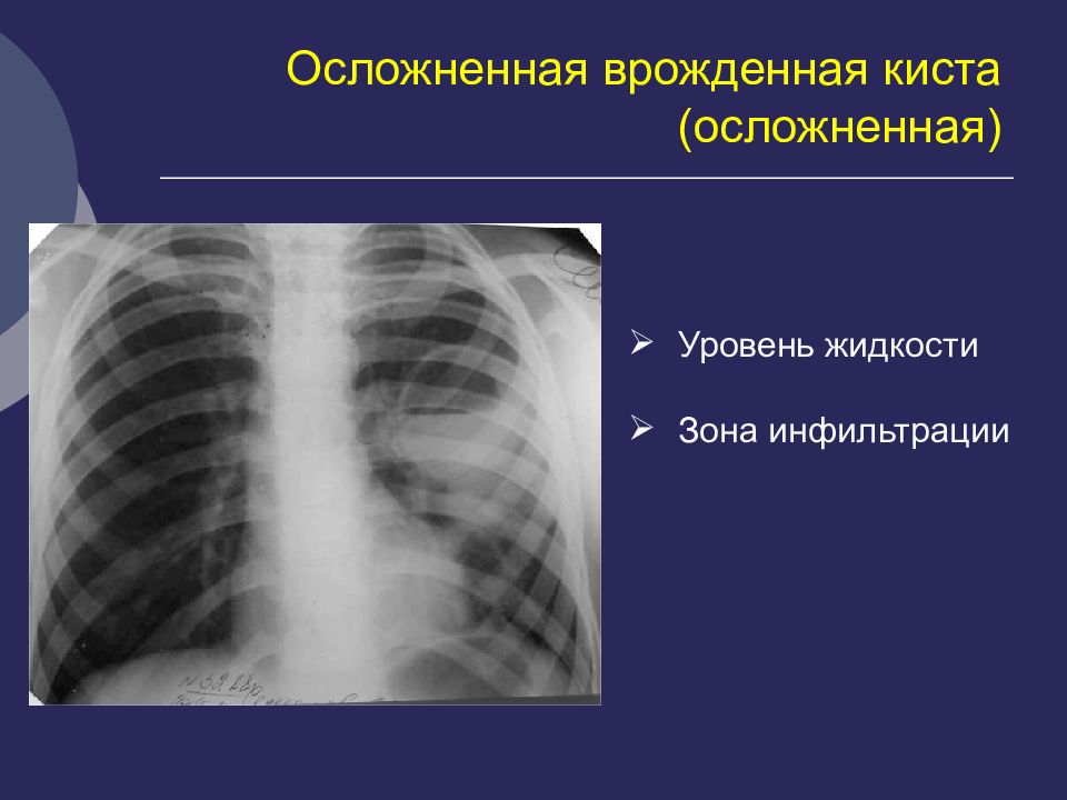 Кисты легких у детей презентация