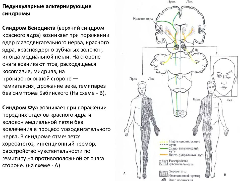 Альтернирующие синдромы схема