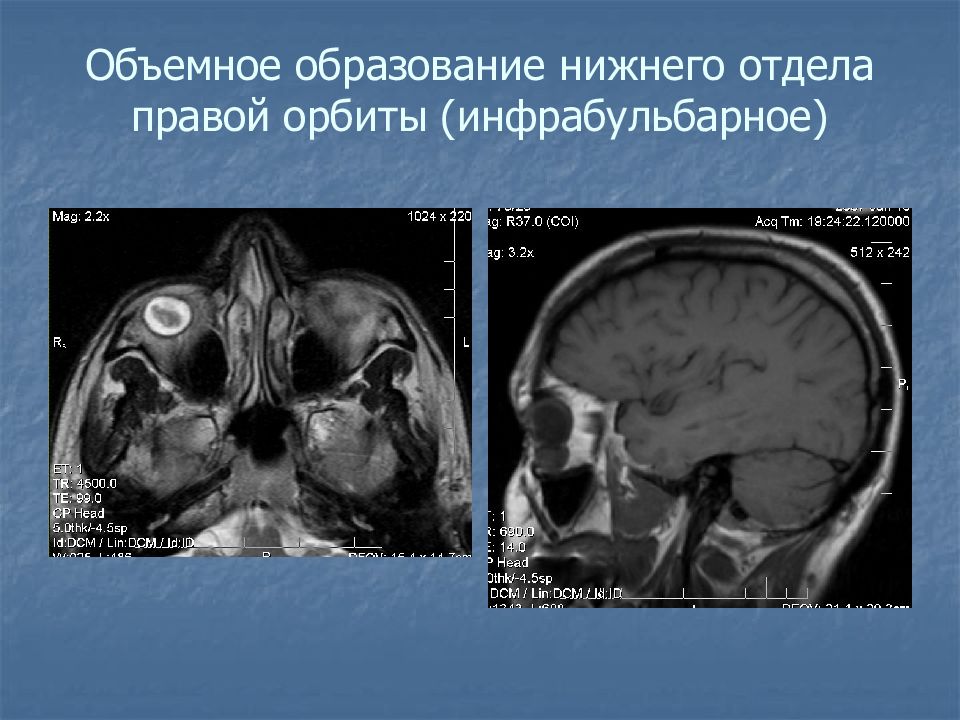 Объемное образование. Объемное образование орбиты. Объемное образование правой орбиты.