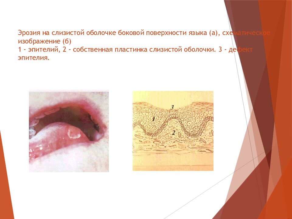 Эрозия на слизистой оболочке боковой поверхности языка (а), схематическое изображение (б) 1 - эпителий, 2 - собственная пластинка слизистой оболочки. 3 -