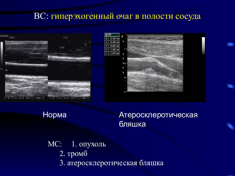 Синус гиперэхогенный. Гиперэхогенная бляшка. Гипоэхогенная бляшка. Изоэхогенная атеросклеротическая бляшка.