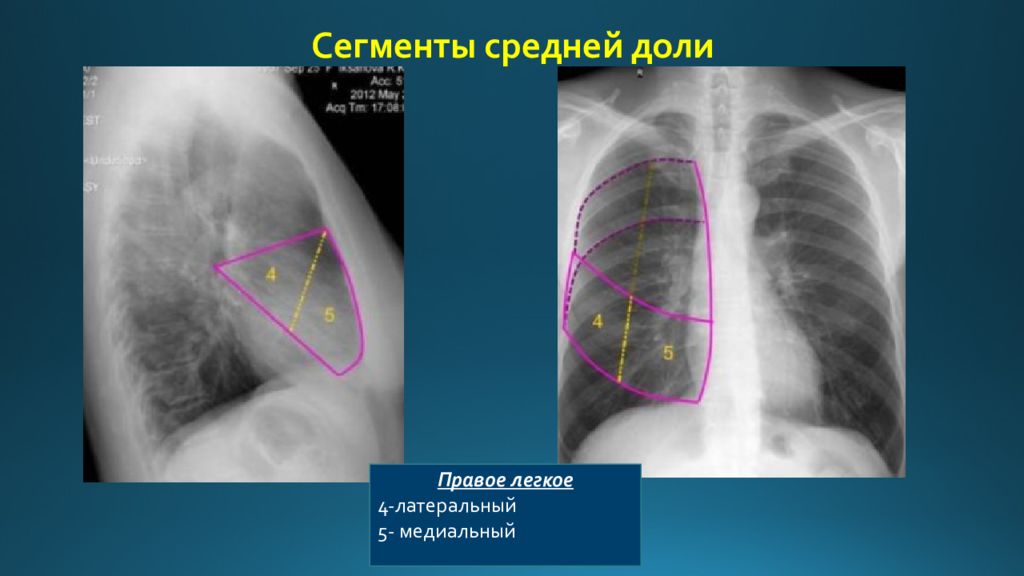 Доли легкого на рентгенограмме. Сегменты верхней доли правого лёгкого. Сегментарное строение легких рентген. Доли левого легкого рентген.
