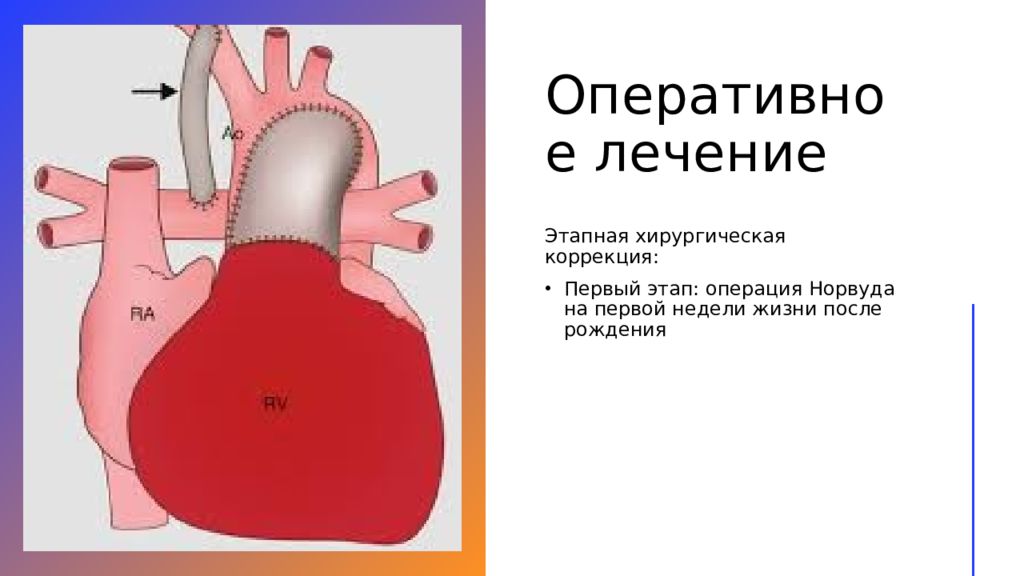 Гипоплазия левых отделов. Операция СГЛОС Норвуда. Синдром гипоплазии левого сердца. Гипоплазия левых отделов сердца. Операция Норвуда у новорожденных.