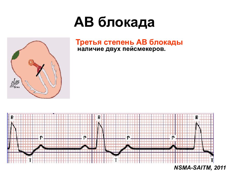 Сердца степени. Полная АВ блокада проксимальный Тип;. АВ блокада 3 степени проксимальный Тип. Дистальная АВ блокада 3 степени. АВ блокада 3 степени дистальный Тип.