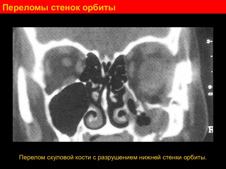 Перелом медиальной стенки орбиты