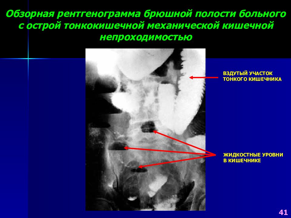 Рентгенография брюшной полости. Обзорная рентгенография брюшной полости кишечная непроходимость. Рентгенограмма больного с толстокишечной непроходимостью. Обзорная рентгенограмма больного с толстокишечной непроходимостью. Обзорная рентгенограмма брюшной полости кишечная непроходимость.
