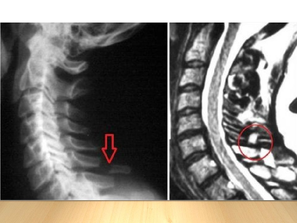 Перелом шейного позвонка фото