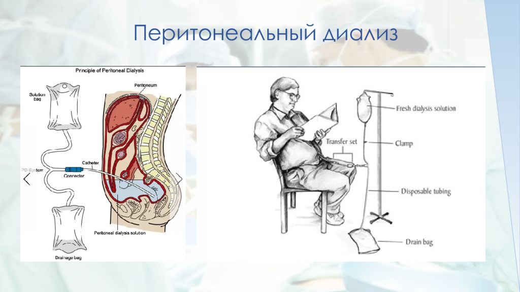 Перитонеальный диализ. Интраперитонеальный диализ. Перитонеального лаважа-диализа. Схема проведения перитонеального диализа. Перитонеальный диализ алгоритм выполнения.