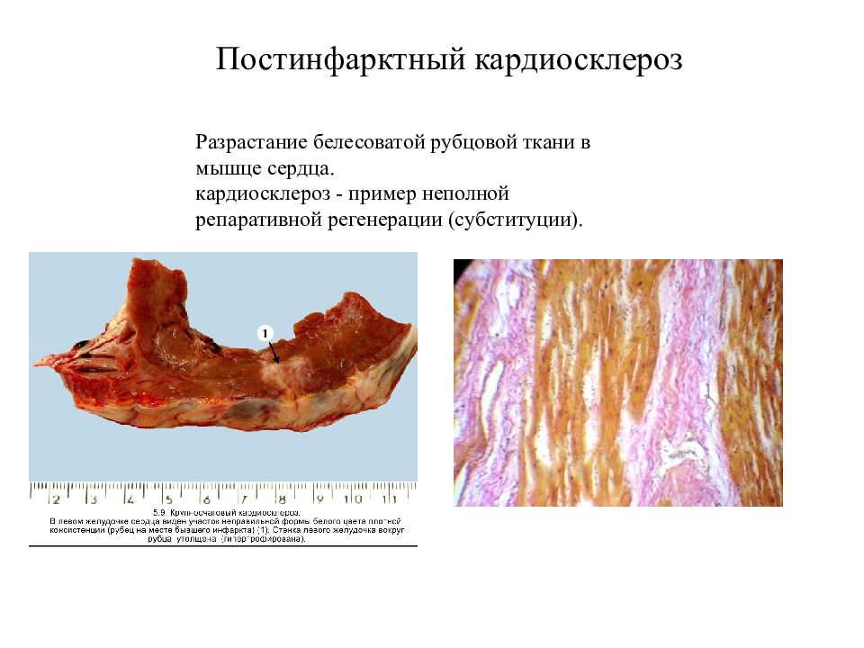 Постинфарктный кардиосклероз презентация