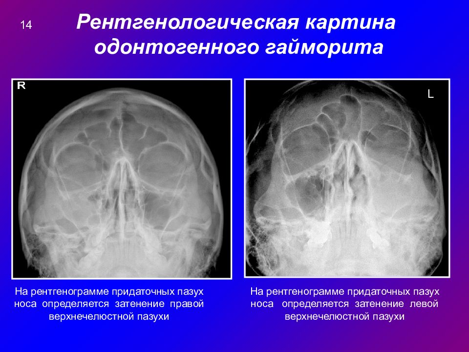 Рентгенологическая картина синусита