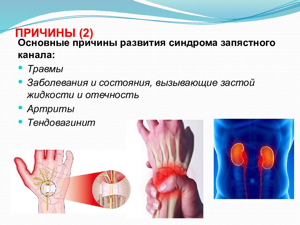 Синдром запястного канала картинки