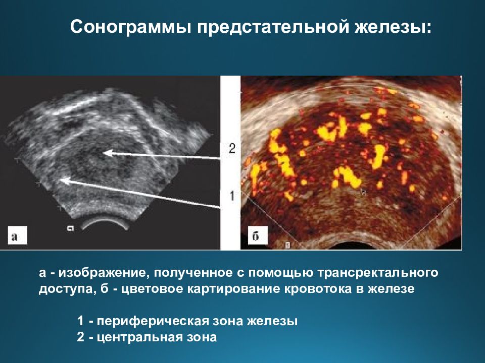 Зоны простаты на узи схема