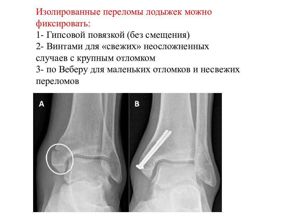 Закрытый перелом нижней трети голени. Перелом лодыжки по Веберу. Изолированный перелом это.