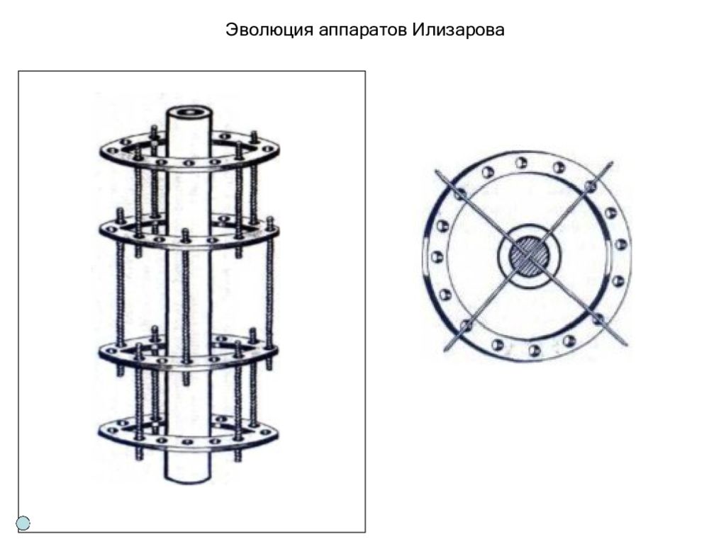Аппарат Илизарова — презентация