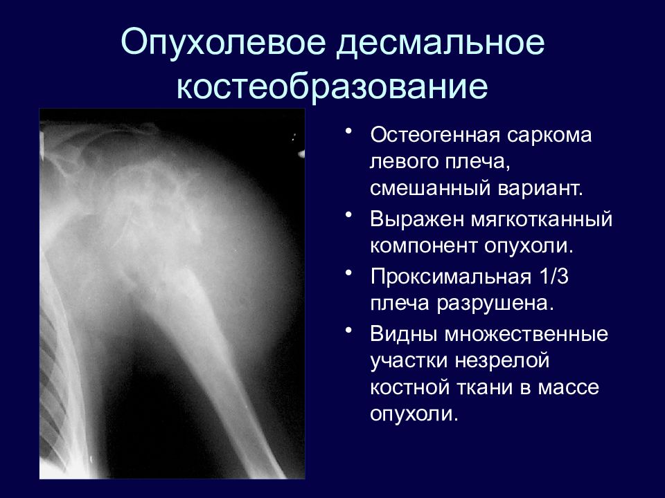 Патологическим костеобразованием напоминающим картину саркомы осложняется