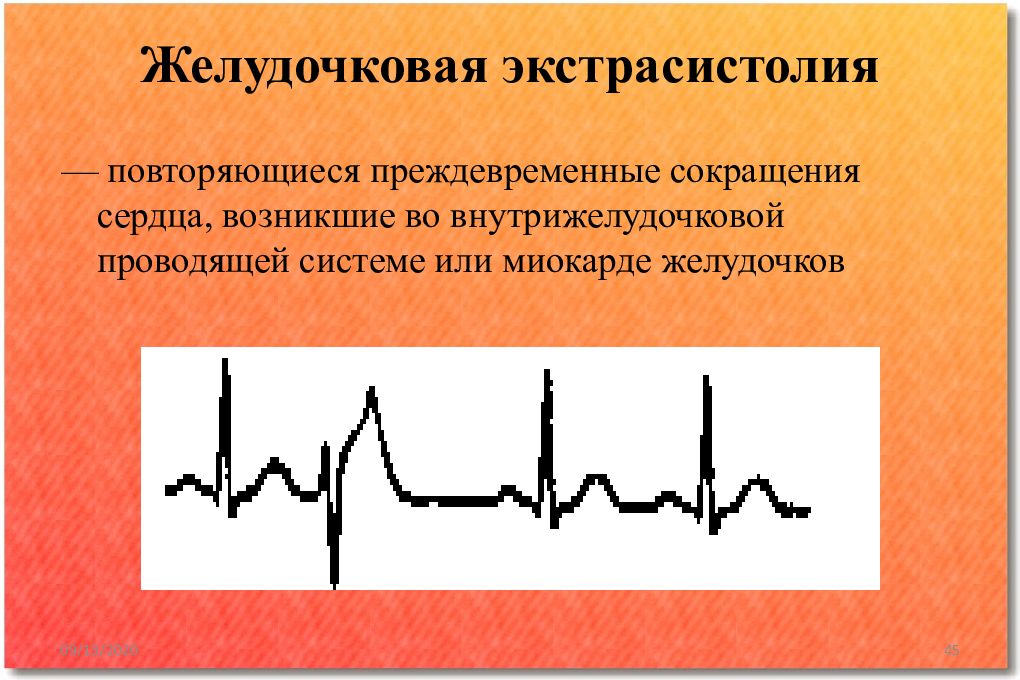 Желудочковая экс. Экстрасистолия нарушение проводимости. Экстрасистолия классификация. Желудочковая экстрасистолия. Экстрасистолия сердца.