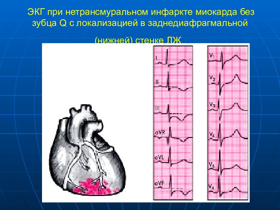 Миокарда левой стенки. Острый трансмуральный инфаркт нижней стенки миокарда ЭКГ. Острый заднедиафрагмальный инфаркт миокарда ЭКГ. Нетрансмуральный инфаркт миокарда на ЭКГ. Нижний трансмуральный инфаркт миокарда на ЭКГ.