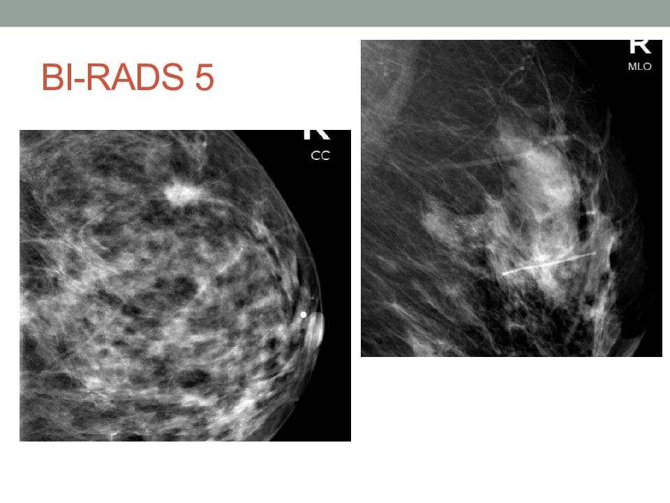 Что означает bi rads 2 узи. Очаговая патология молочной железы bi-rads 0. Маммография молочных желез bi rads 1. Категория bi-rads. Слайды заболевания молочной железы.