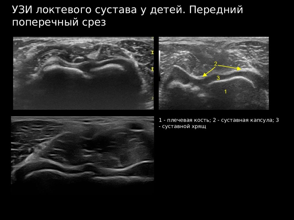 Протокол узи локтевого сустава образец