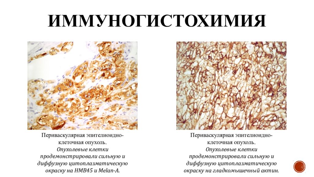 Игх исследование. Иммуногистохимия принцип метода. Иммуногистохимические маркеры опухолей. Иммуногистохимический метод окрашивание. Иммуногистохимический метод диагностики.