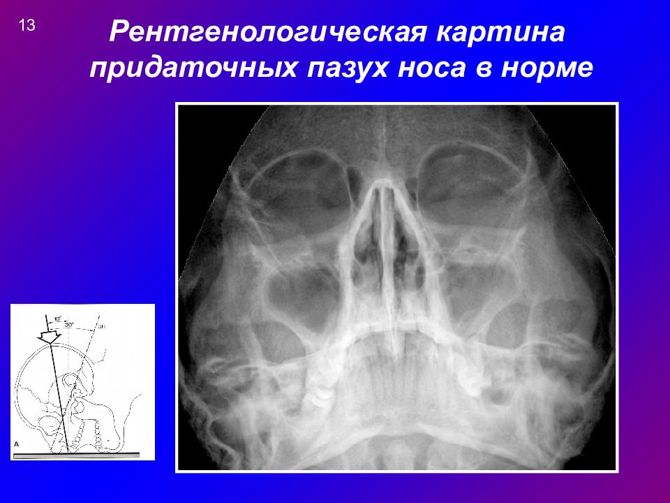 Расшифровка снимка. Рентген придаточных пазух норма. Рентген придаточных пазух носа синусит. Рентгенография придаточных пазух носа норма.