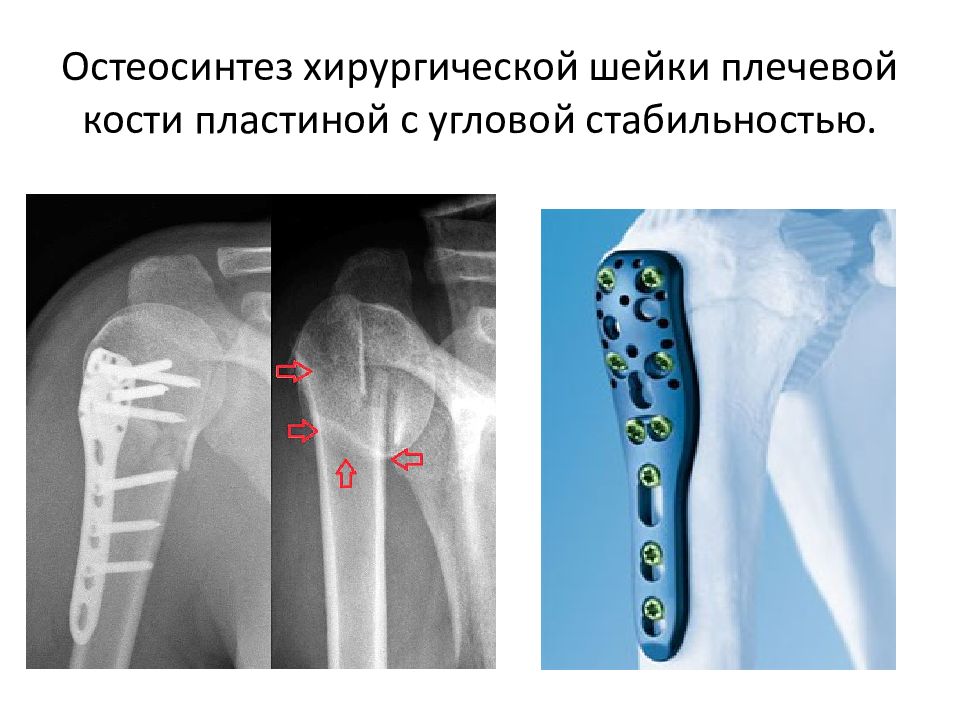 Травматология переломы презентация