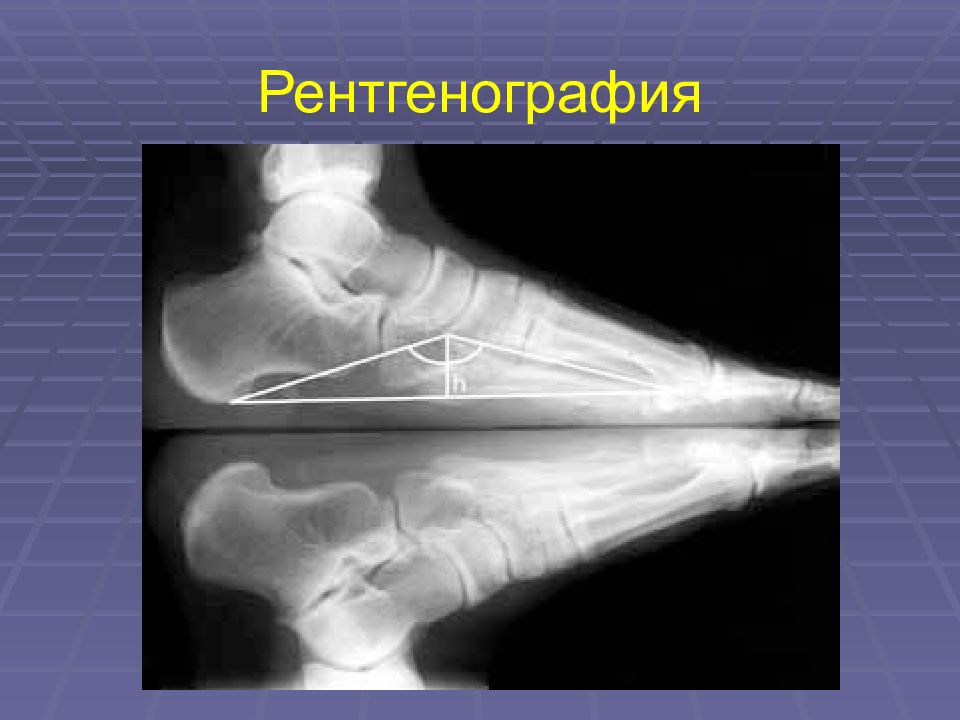 Как правильно делать рентген стоп. Продольное плоскостопие рентген степени. Плоскостопие 3 степени рентген. Поперечное плоскостопие рентген. Продольное плоскостопие 3 степени рентген.