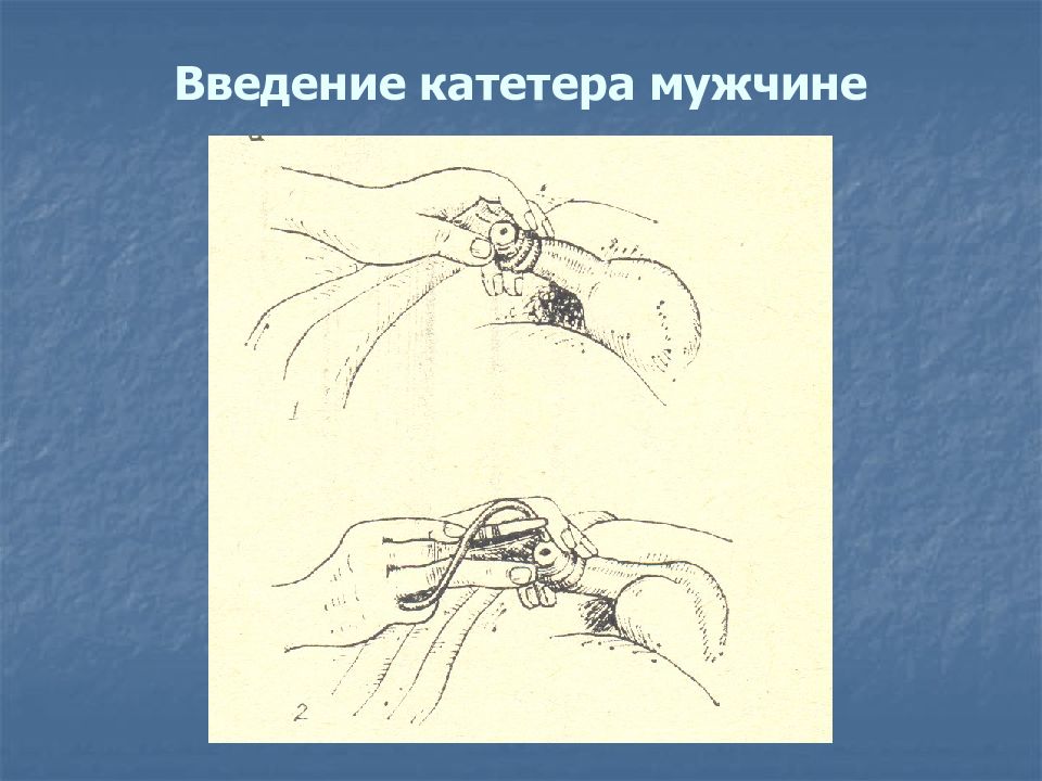 Введение катетера мужчинам. Введение катетера мужчине. Введение мочевого катетера мужчине. Введение металлического катетера мужчине этапы. Введение ворд катетера.
