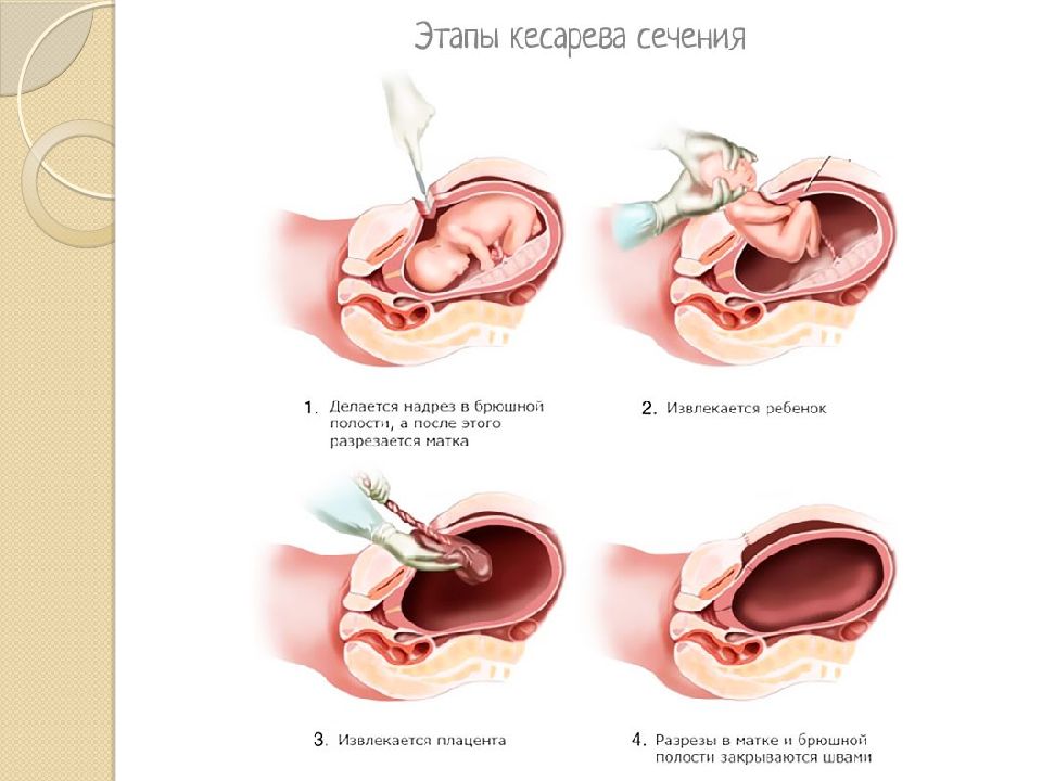 На какие сутки приходит молоко после кесарева. Кесарево сечение Акушерство.