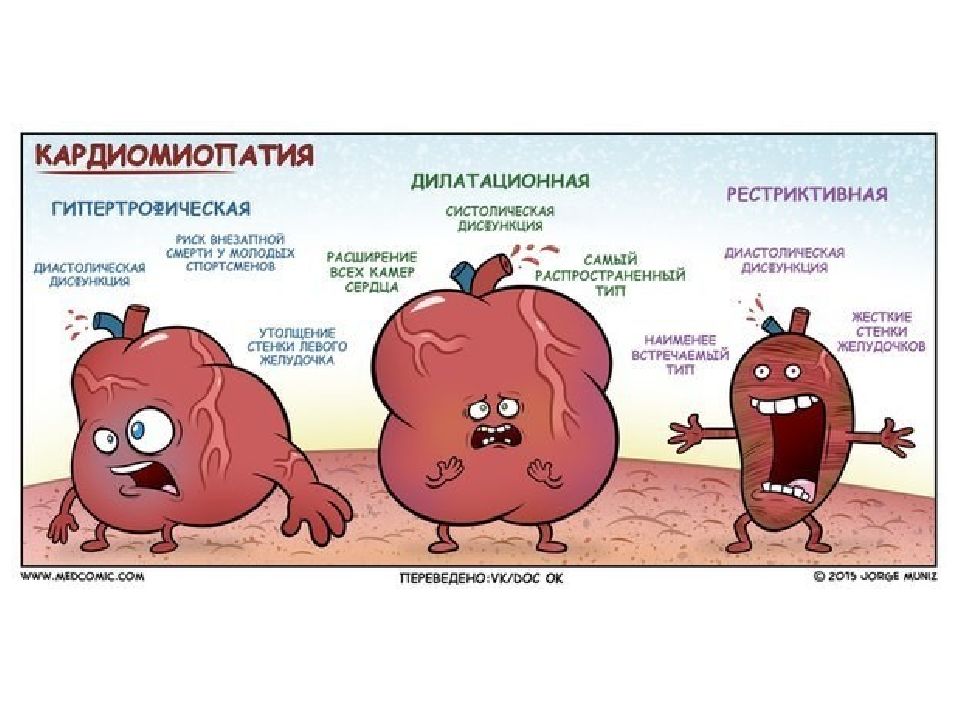 Дилатационная кардиомиопатия презентация