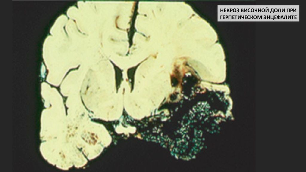 Герпетический энцефалит. Патоморфология герпетического энцефалита. Герпетический энцефалит макропрепарат. Амебный менингоэнцефалит. Энцефалит патанатомия.