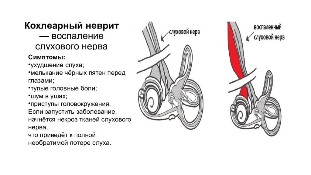 Неврит слухового нерва симптомы