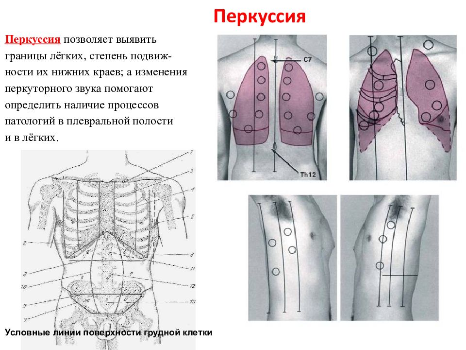 Перкуссия легких презентация