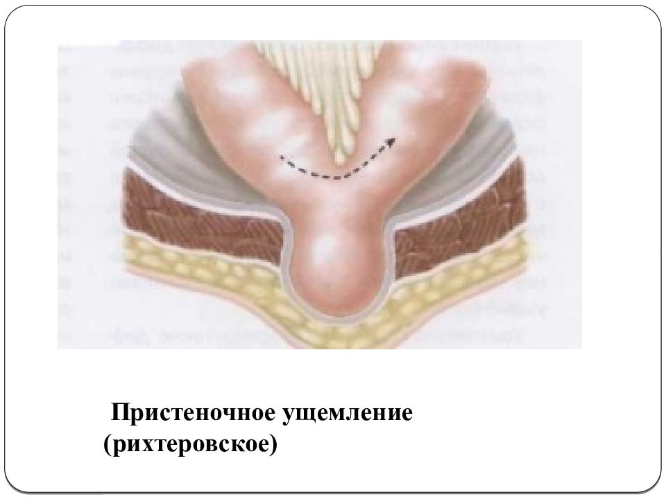 Ущемленная грыжа Рихтера. Пристеночное ущемление грыжи. Пристеночное ущемление (грыжа Рихтера).