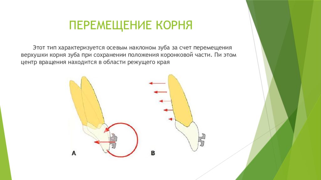 Тип перемещения. Биомеханика перемещения зубов. Наклонно вращательное перемещение зуба. Биомеханика в ортодонтии.
