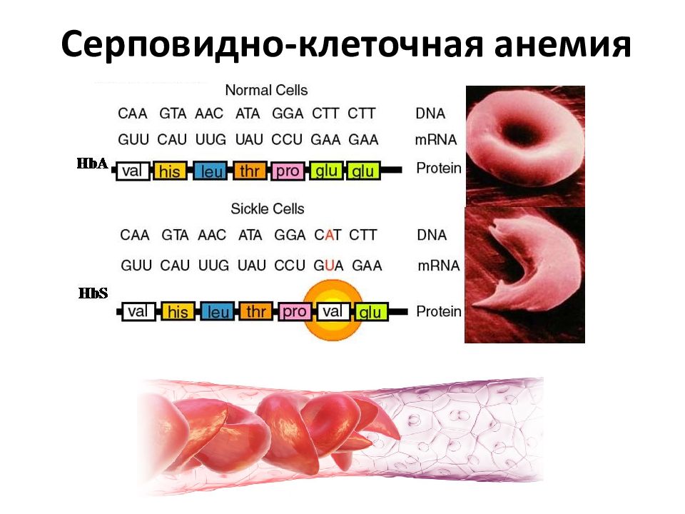 Анемия биохимия. Серповидно клеточная анемия. Серповидно клеточная анемия на УЗИ. Размер белка биохимия.