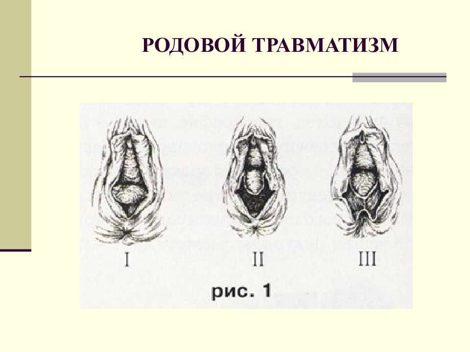 Родовой травматизм презентация