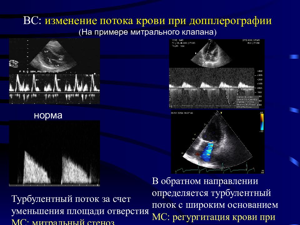 Аортальный стеноз ЭХОКГ. Степени митральной регургитации по ЭХОКГ. ЭХОКГ при митральном стенозе. УЗИ при стенозе митрального клапана.