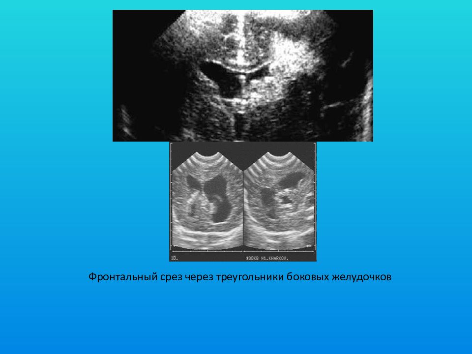 ВЖК 2 степени у новорожденных УЗИ. Срезы при УЗИ. ВЖК 1 степени у новорожденных УЗИ.